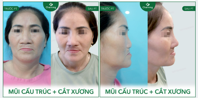 Khách biết tình trạng mũi khó khi chiếc mũi thiếu chiều cao nhưng thừa chiều rộng. Khách chỉ mong muốn một chiếc mũi bình thường, tự nhiên là được.