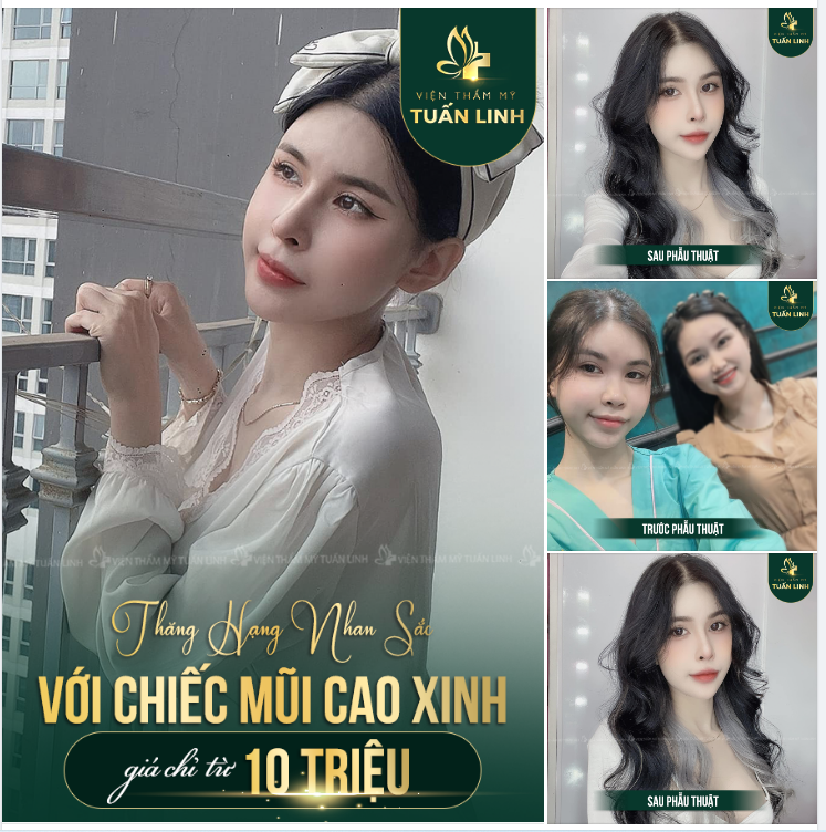 Khách hàng 9X thăng hạng nhan sắc với chiếc mũi cao!!!