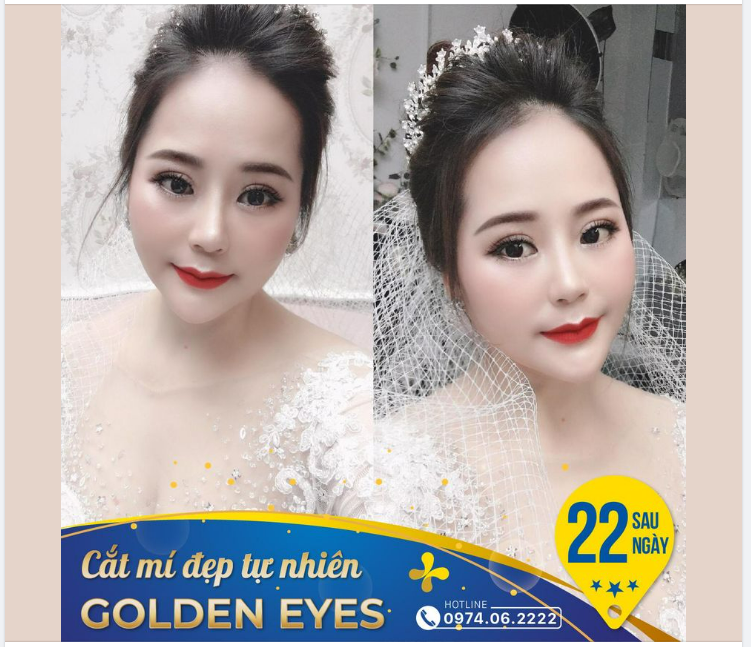 Khách hàng inbox hỏi “Bác sĩ ơi 3 tuần nữa là em chụp ảnh cưới rồi, cắt mí bây giờ liệu có kịp không”