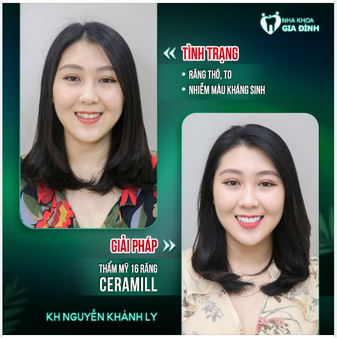 Khách hàng Khánh Ly mong muốn được tay đổi hàm răng của mình bởi răng trước kia của cô hình thể không đẹp, xỉn màu khiến nhan sắc bị ảnh hưởng không nhỏ.
