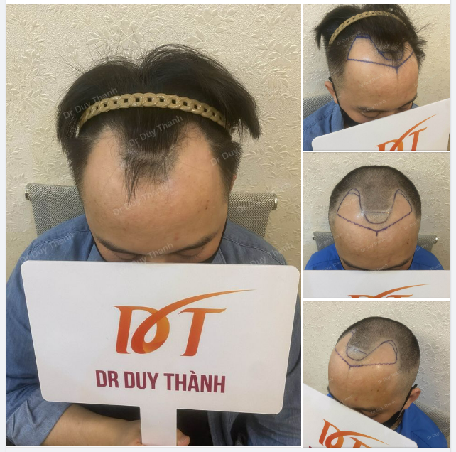 KHÁCH HÀNG NAM BAY TỪ NHẬT VỀ ĐỂ GẶP DR DUY THÀNH CẤY TÓC
