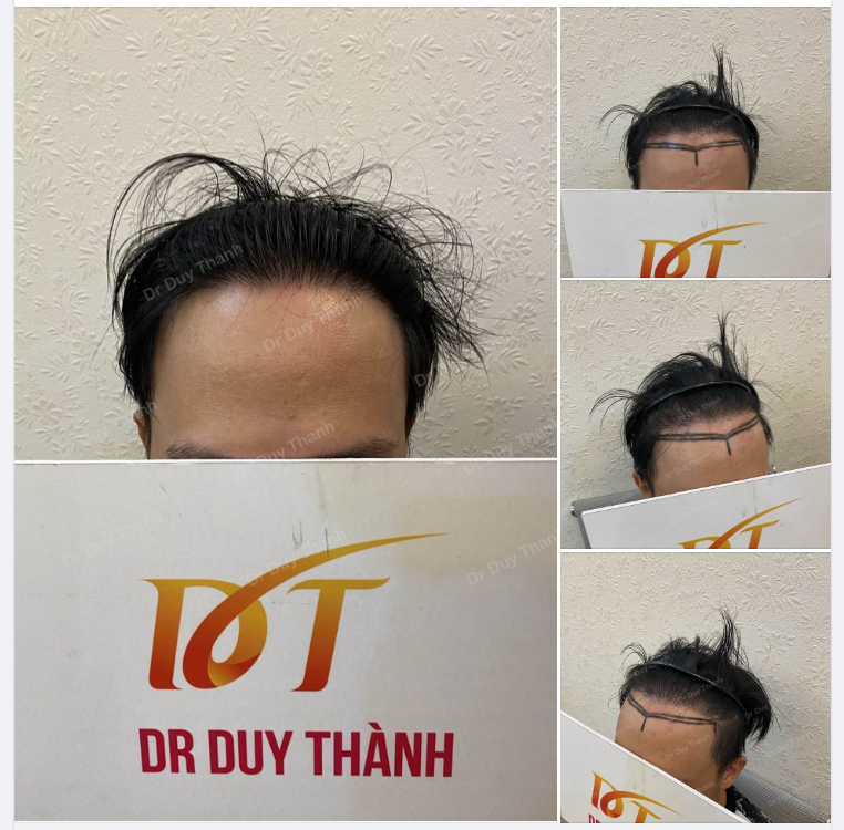 KHÁCH HÀNG NAM TỪ SÀI GÒN RA CẤY TÓC CHỈNH SỬA ĐƯỜNG HAIRLINE, DỰ KIẾN 1300 NANG