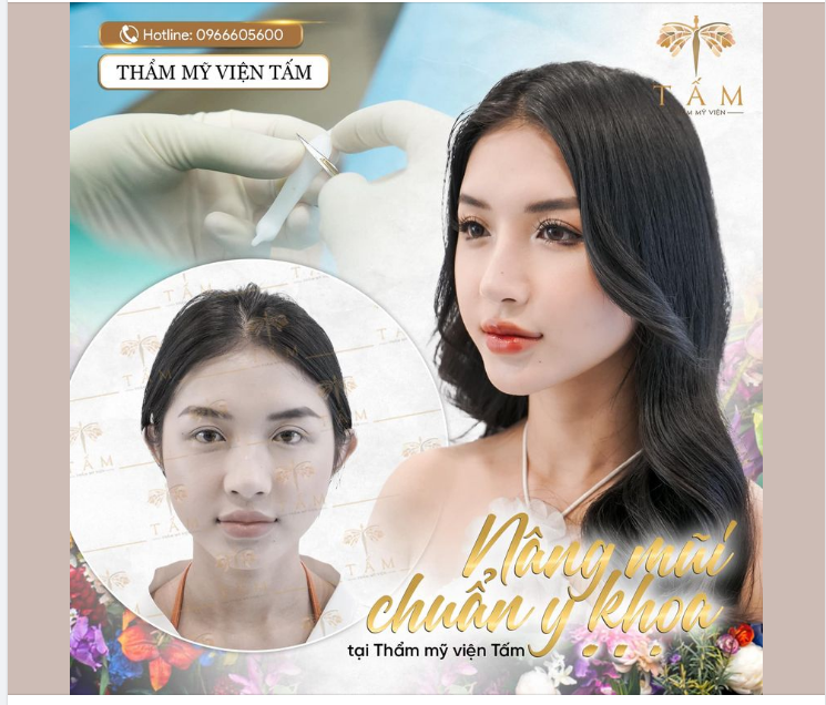 Khách hàng nâng mũi tại Thẩm mỹ viện Tấm sẽ được đảm bảo một quy trình nâng mũi chuẩn y khoa theo các bước như sau