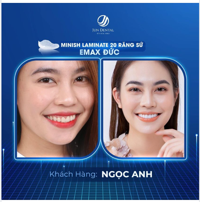 Khách hàng Ngọc Anh quá đỗi rạng ngời cùng với combo 20 răng sứ tại Nha Khoa Thẩm Mỹ Jun Dental.