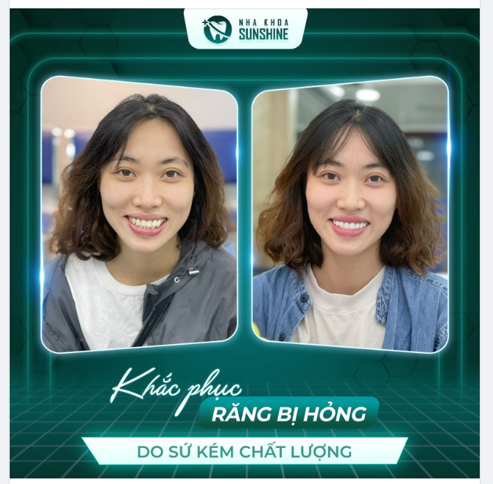 Khách hàng Nguyễn Hồng Hạnh đã từng làm răng sứ ở nha khoa khác.