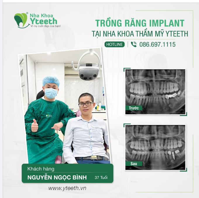 Khách hàng Nguyễn Ngọc Bình (37 tuổi) đến khám trong tình trạng mất răng hàm đã được vài năm.