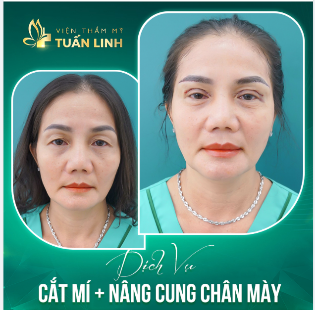 KHÁCH HÀNG U50 TRẺ HÓA NHỜ COMBO CẮT MÍ + NÂNG CUNG CHÂN MÀY