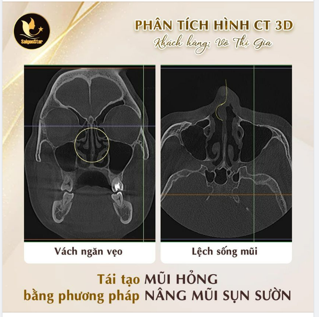 KHÁCH HÀNG VÕ THỊ GIA – MŨI LỆCH – VẸO VÁCH NGĂN