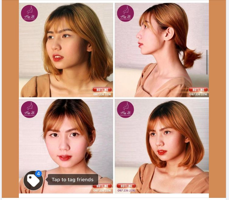 Khi Khách hàng nhà Hiệp Lợi cực kì thích Form mũi tự nhiên