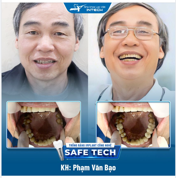 KHÔI PHỤC CHỨC NĂNG ĂN NHAI BẰNG TRỒNG RĂNG IMPLANT CÔNG NGHỆ SAFE TECH