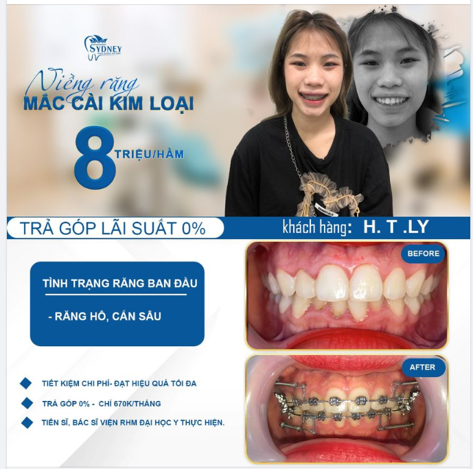 KHÔNG BAO GIỜ LÀ QUÁ MUỘN ĐỂ NIỀNG RĂNG