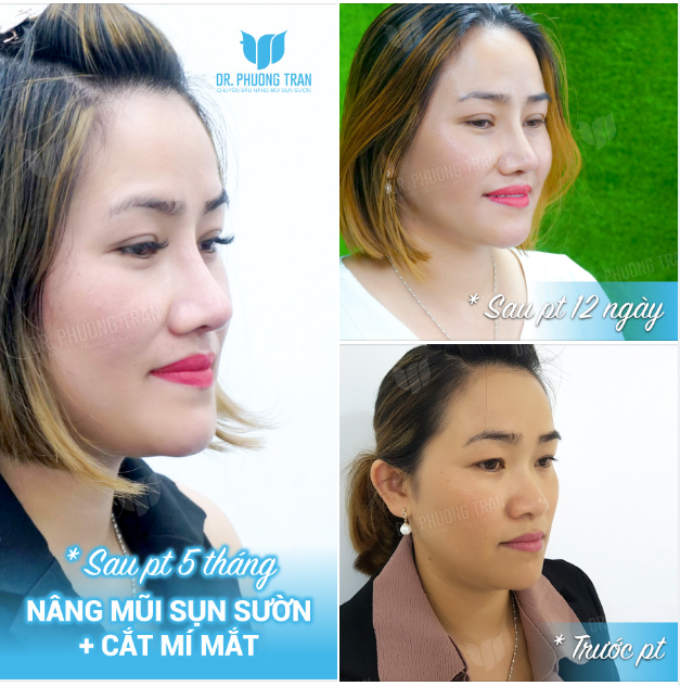 Không có ảnh quá khứ thì ai biết được bạn ấy làm COMBO SỤN SƯỜN + CẮT MẮT