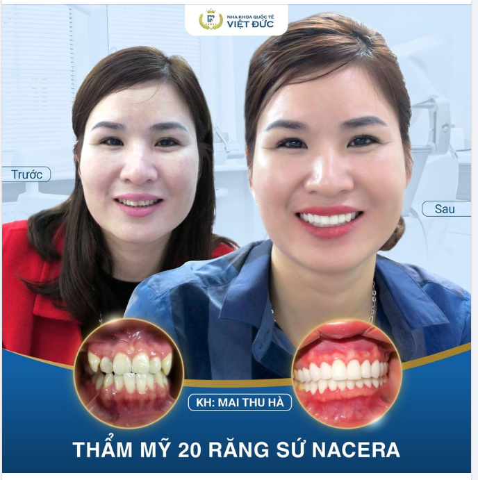 KHÔNG CÒN RĂNG KHẤP KHỂNH, TỰ TIN NỤ CƯỜI XINH!!!