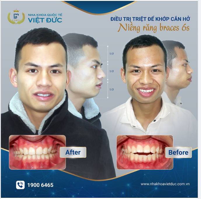 KHỚP CẮN HỞ, PHẢI LÀM SAO?