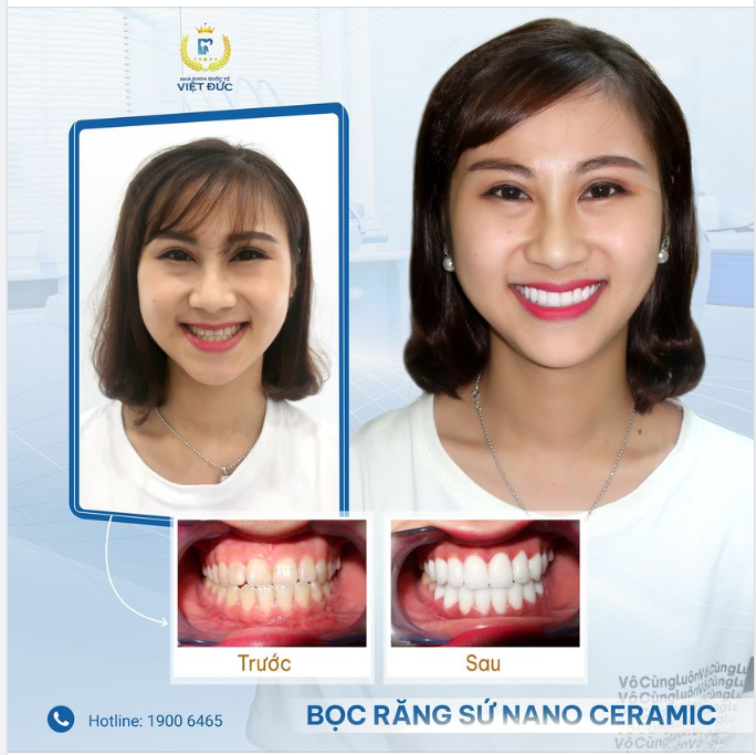 KHỚP CẮN NGƯỢC, BỌC RĂNG SỨ ĐƯỢC KHÔNG?
