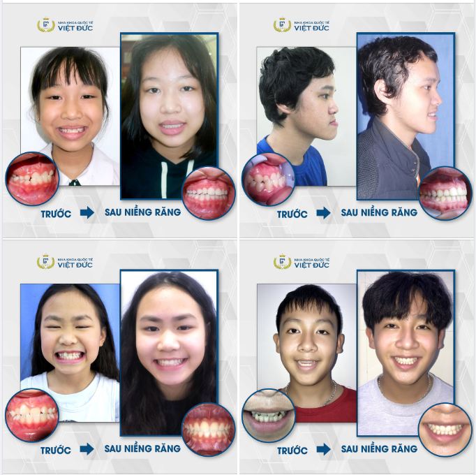 KHỚP CẮN NGƯỢC - NIỀNG RĂNG CÀNG SỚM