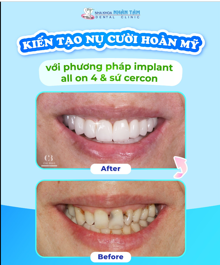 KIẾN TẠO NỤ CƯỜI HOÀN MỸ VỚI PHƯƠNG PHÁP IMPLANT ALL ON 4 & SỨ CERCON