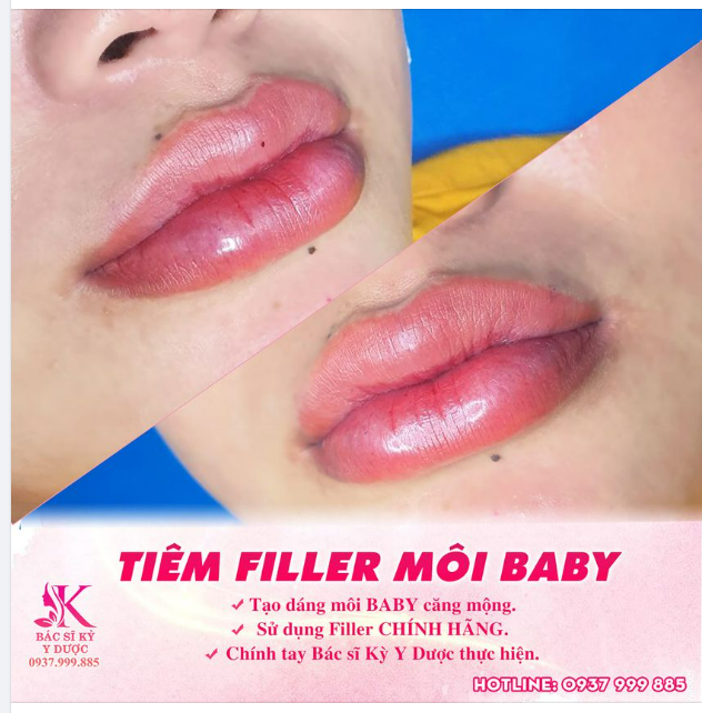 Kiến thức về sự khác nhau giữa Filler và silicon lỏng 