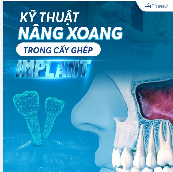 KỸ THUẬT NÂNG XOANG TRONG CẤY GHÉP IMPLANT