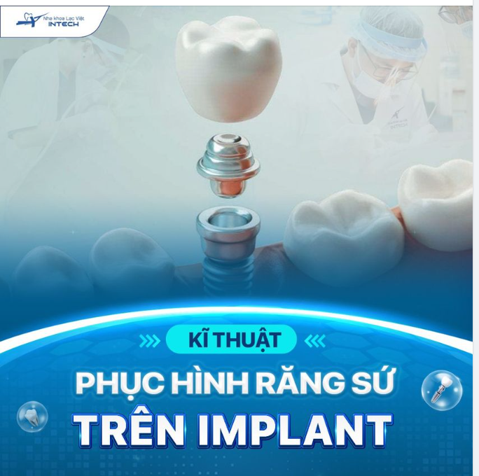 KỸ THUẬT PHỤC HÌNH RĂNG SỨ TRÊN IMPLANT