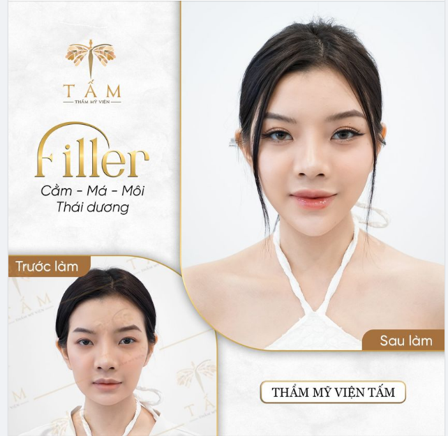 Làm đẹp đơn giản, nhanh chóng bằng Filler