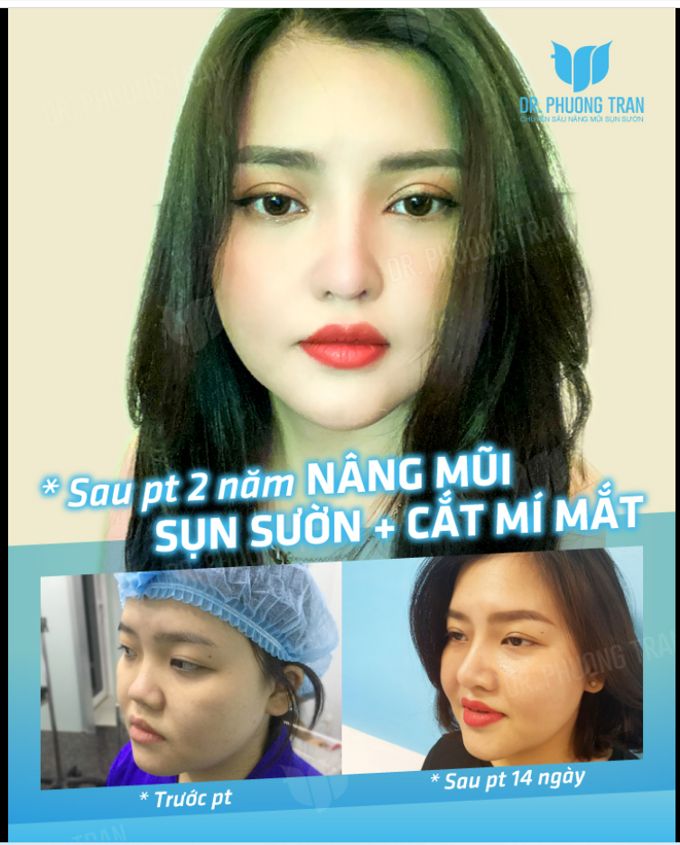 Làm Sụn Sườn Lúc Đầu Đẹp Thế Thôi, Chứ Mấy Năm Sau…Còn “Bá Cháy” Hơn Nữa!