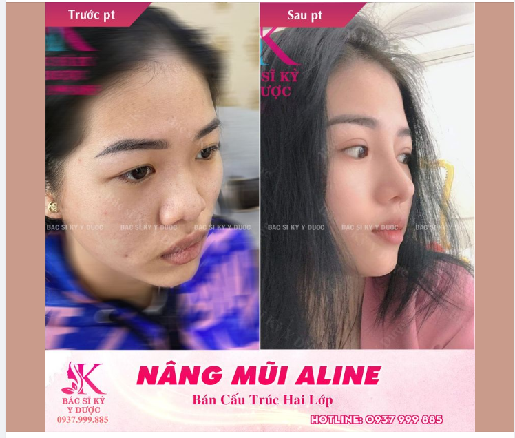 LÀM THẾ NÀO ĐỂ CÓ CHIẾC MŨI HOÀN HẢO MÀ KHÔNG CẦN PHẪU THUẬT