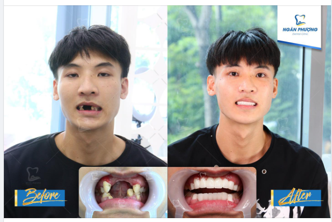 Lấp đầy khoảng thiếu, lột xác chuẩn soái ca sau khi làm răng