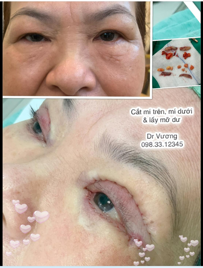 Lâu lâu mới cắt mí mà phải lấy mỡ, mắt của chị í dư mỡ quá nhiều nên bs mới lấy nhé, chứ mắt của các bạn trẻ nên xử trí dàn bọng mỡ thôi, chứ ko nên lấy bỏ !