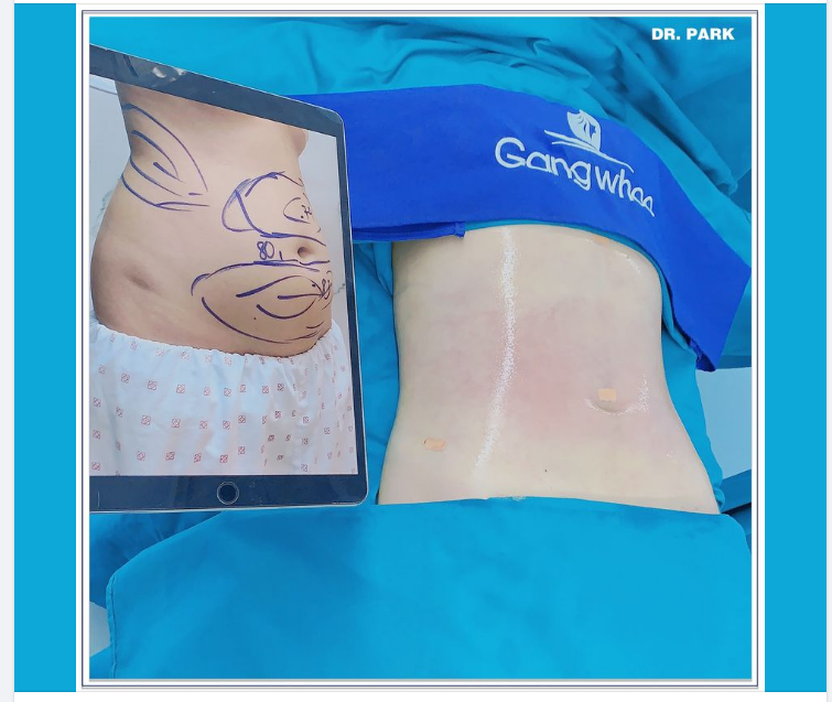 LIPO ULTRASOUND – GIẢI PHÁP GIẢM MỠ DÀNH TẶNG CHO MẸ SAU SINH