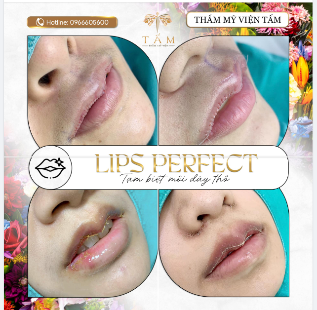 LIPS PERFECT - Tạm biệt dáng môi dày thô