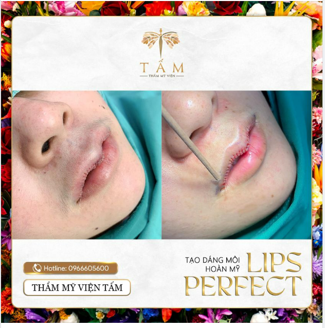 LIPS PERFECT - Tạo dáng môi hoàn mỹ