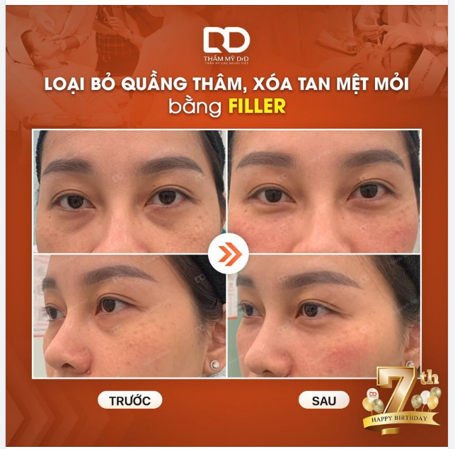 LOẠI BỎ QUẦNG THÂM, XÓA TAN MỆT MỎI VỚI FILLER