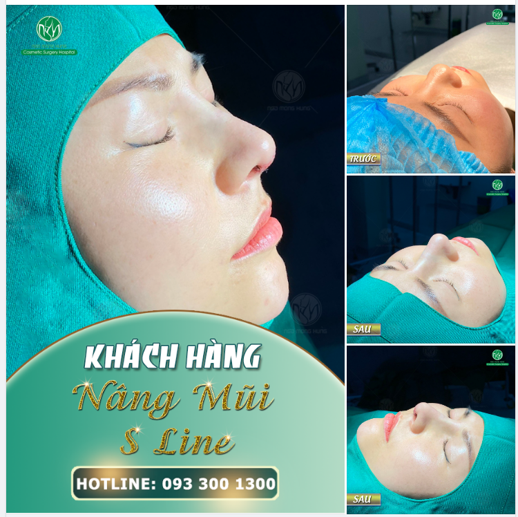 LỘT XÁC TOÀN DIỆN SAU NÂNG MŨI S LINE