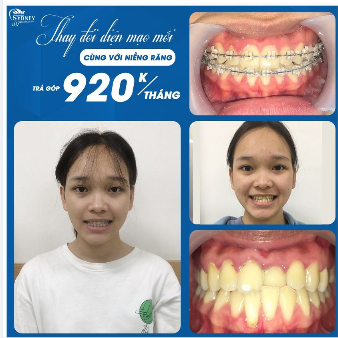 LƯU Ý SAU NIỀNG RĂNG Ở TRẺ NHỎ
