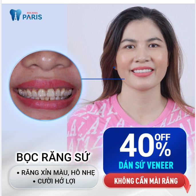 LÝ DO KHIẾN HÀNG NGÀN NGƯỜI LỰA CHỌN DÁN SỨ VENEER TẠI NHA KHOA PARIS