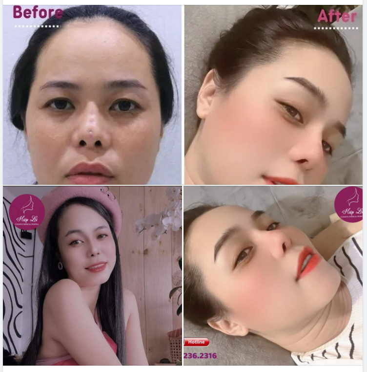 MẤT BAO NHIÊU ĐỂ SỬA 1 CHIẾC MŨI HỎNG