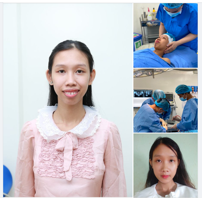 Mặt cân đối hài hoà chuẩn Hot girl sau quá trình Phẫu thuật hàm hô + Trượt Cằm Tại Bệnh viện RHM Thẩm mỹ Paris