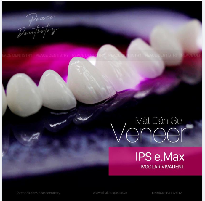 Mặt dán sứ Veneer IPS e.Max - Ivoclar Vivadent