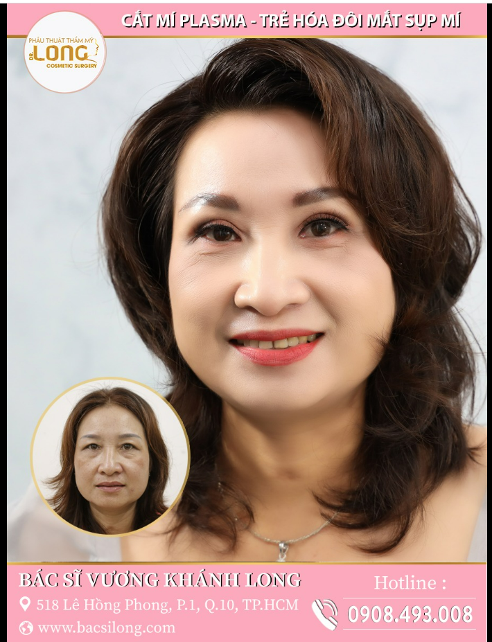 Mắt đẹp mắt xinh cắt mí ngay hôm nay nhận ưu đãi bỏng tay