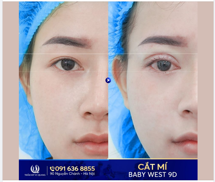 Mắt mí sụp, mí lót, 1 mí là chuyện nhỏ !
