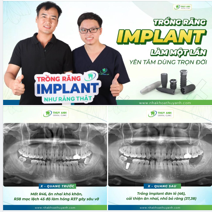 MẤT RĂNG HÀM LỚN VÀ HƯỚNG ĐIỀU TRỊ HIỆU QUẢ