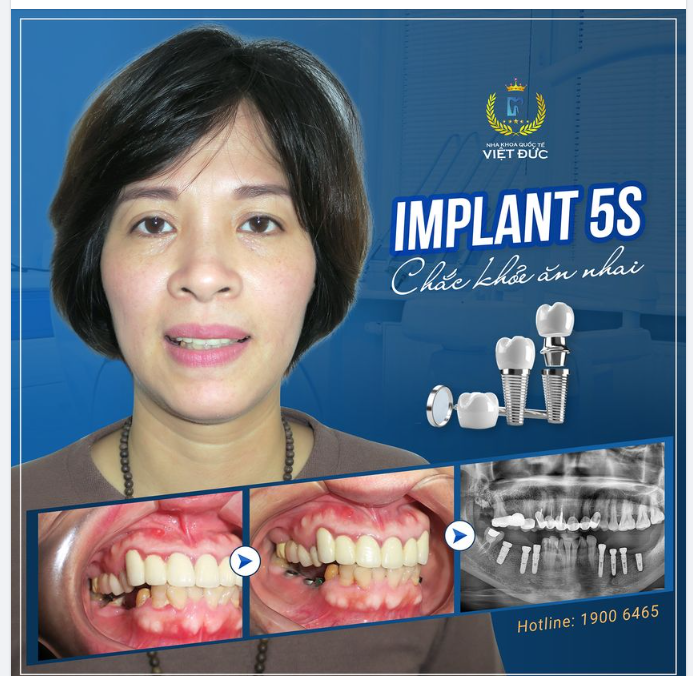 MẤT RĂNG - TIỀM ẨN NHỮNG NGUY HẠI KHÔN LƯỜNG