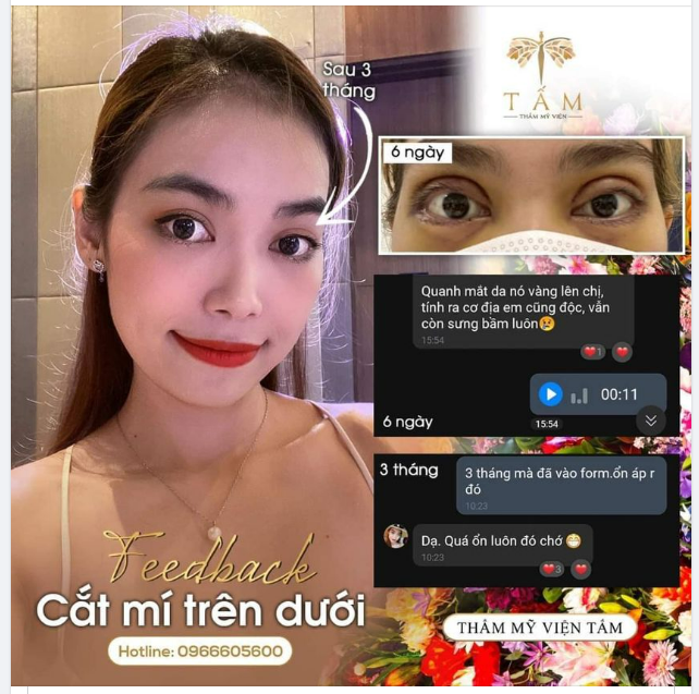 Mắt sưng nề sau khi cắt mí trên dưới, hai mí không đều.