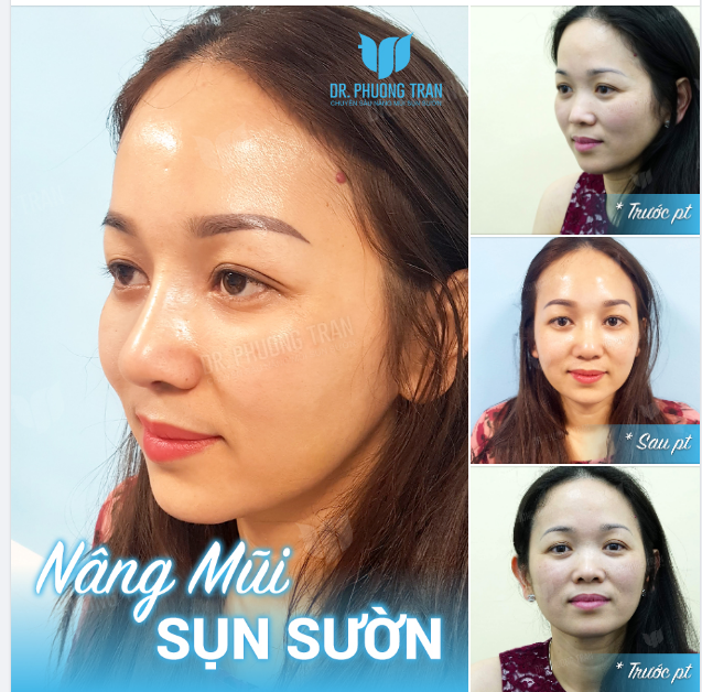 Mẹ sinh chiếc mũi to bè. Em tìm bác sĩ chuyển bè thành cao…!