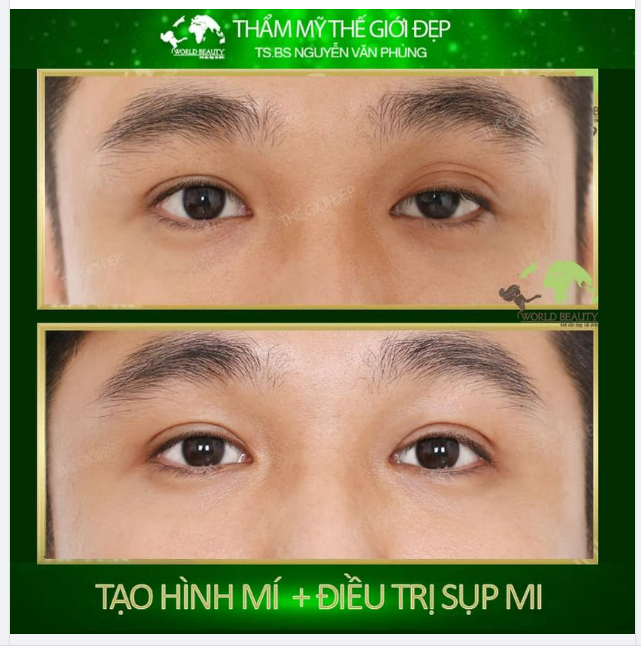 Mí mắt Khách hàng Nam thay đổi sau 10 NGÀY thực hiện ph.ẫu th.uật Tạo hình mí mắt kết hợp điều trị Sụp mí tại Thế Giới Đẹp!