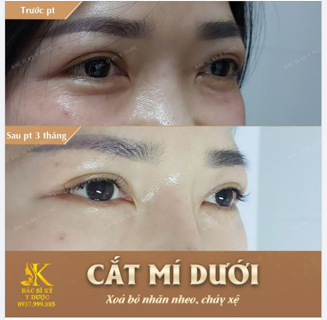 Mỡ thừa vùng mắt là nỗi lo của rất nhiều Chị Em Phụ Nữ! Dấu hiệu tuổi tác và dấu ấn của thời gian sẽ hiện hữu rõ ràng trên đôi mắt .