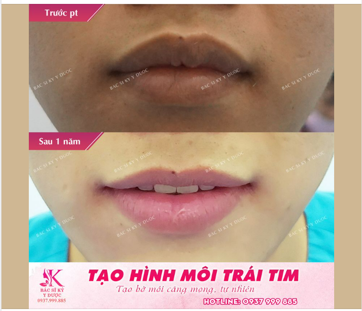 Môi xinh quyến rũ Chỉ với 30 phút phẫu thuật tạo hình môi trái tim