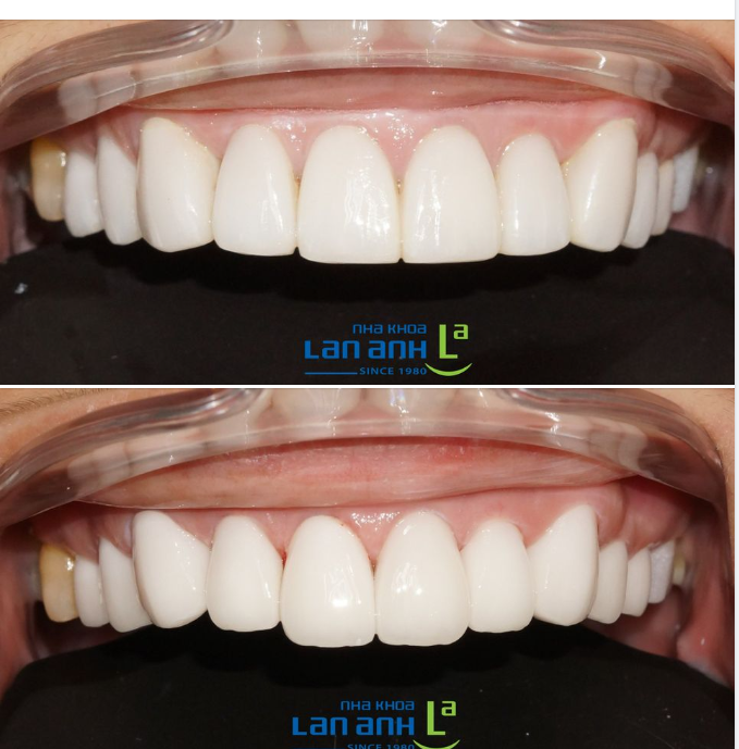  Một ca làm lại Veneer sứ đã điều trị tại nơi khác của nha khoa Lan Anh chi nhánh Phú Mỹ Hưng, bác sĩ Tú!