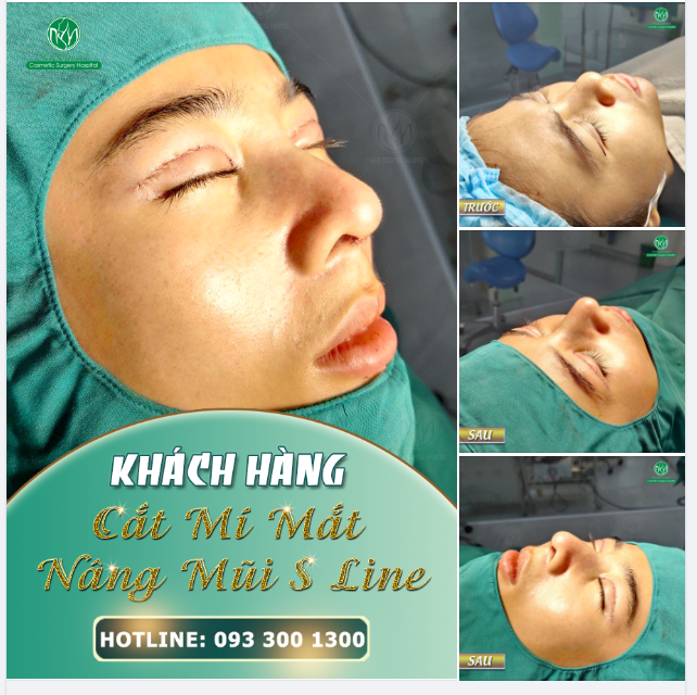 MỘT CA NÂNG MŨI KẾT HỢP CẮT MÍ CUỐI NGÀY